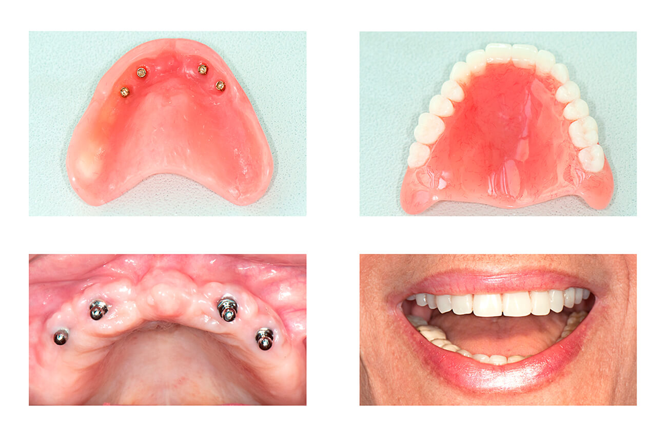 Cost of Dental Implants in Mexico Dentraveller