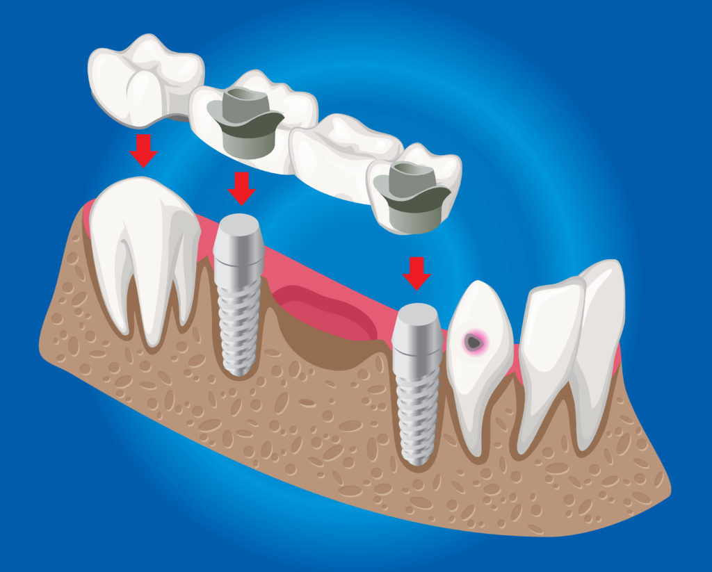 Bridge implant cost dental implants mexico