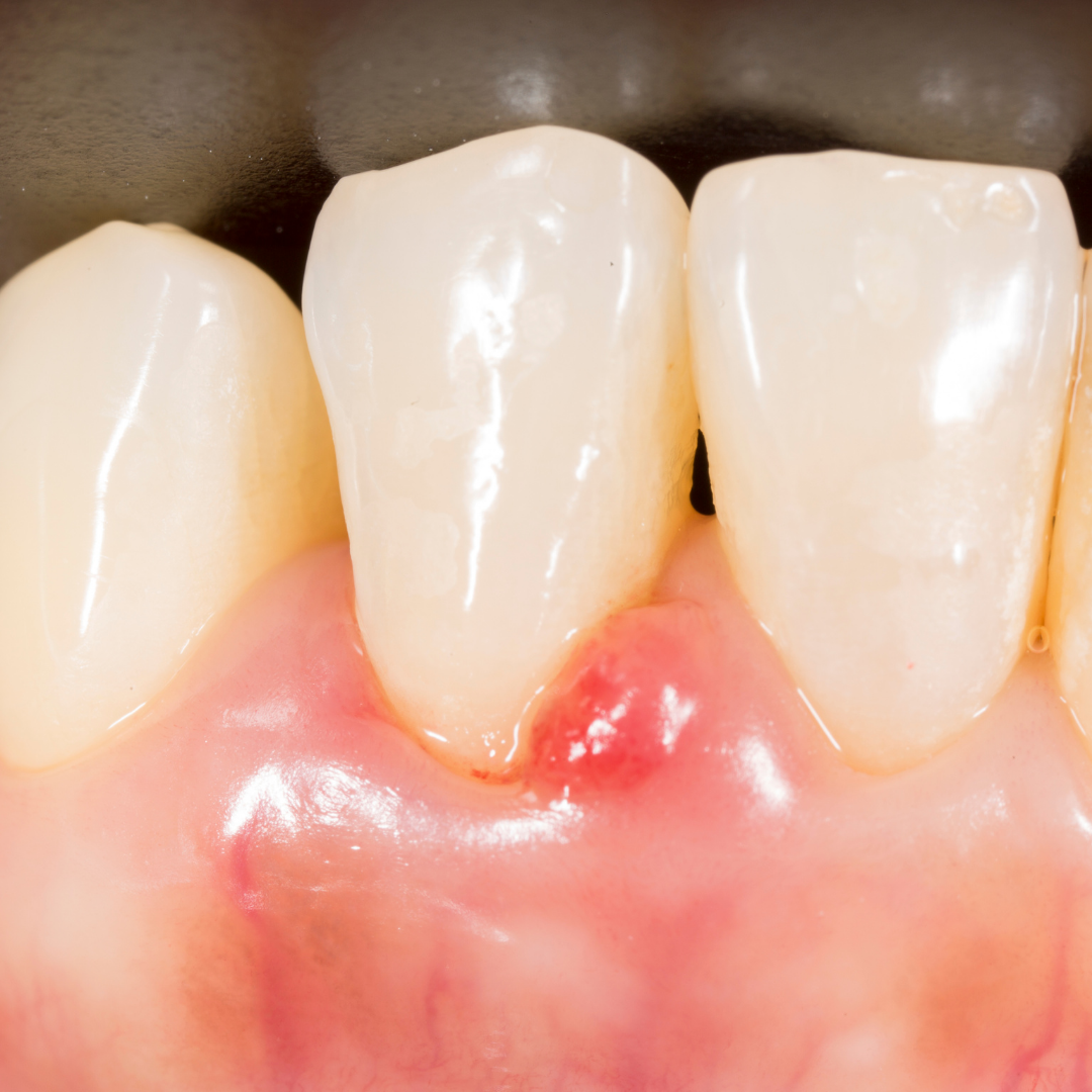 periodontal / gum disease