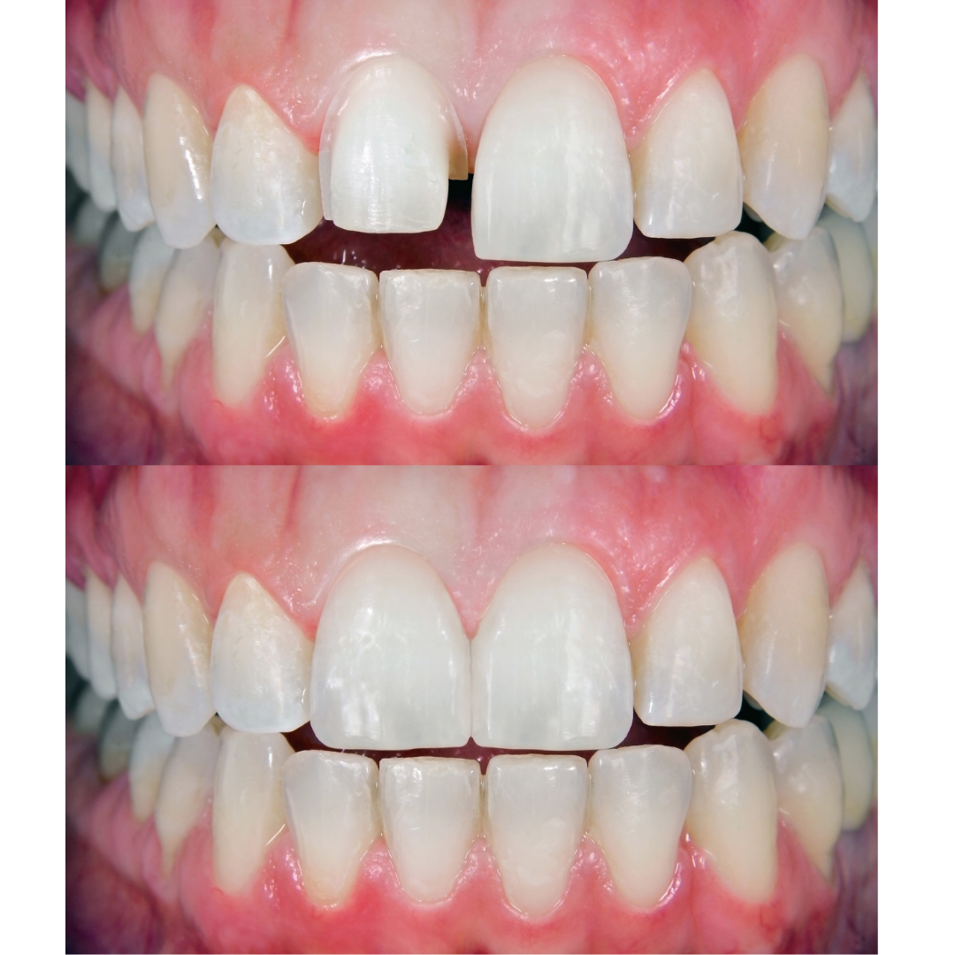 dental-veneers-dentraveller